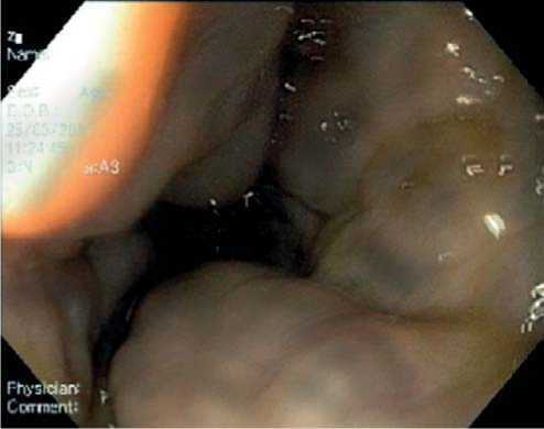 Эндоскопическая картина ВРВ пищевода при тромбозе воротной вены