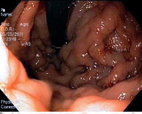 Эндоскопическая картина ВРВ желудка при тромбозе воротной вены